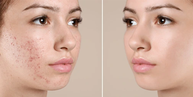 Acne-Treatment-for-Pimples
