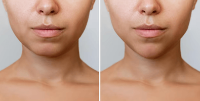 Dermal-Fillers-Treatment
