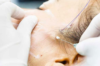 Threadlift Treatment in Mumbai